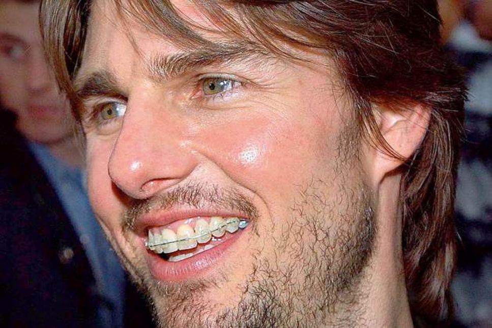 Tom Cruise med sin tandställning med NASA-teknik